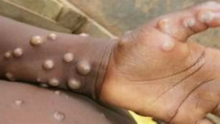 MonkeyPox Bihar: Health Department has issued guidelines regarding monkey pox, know what are the ways to avoid it