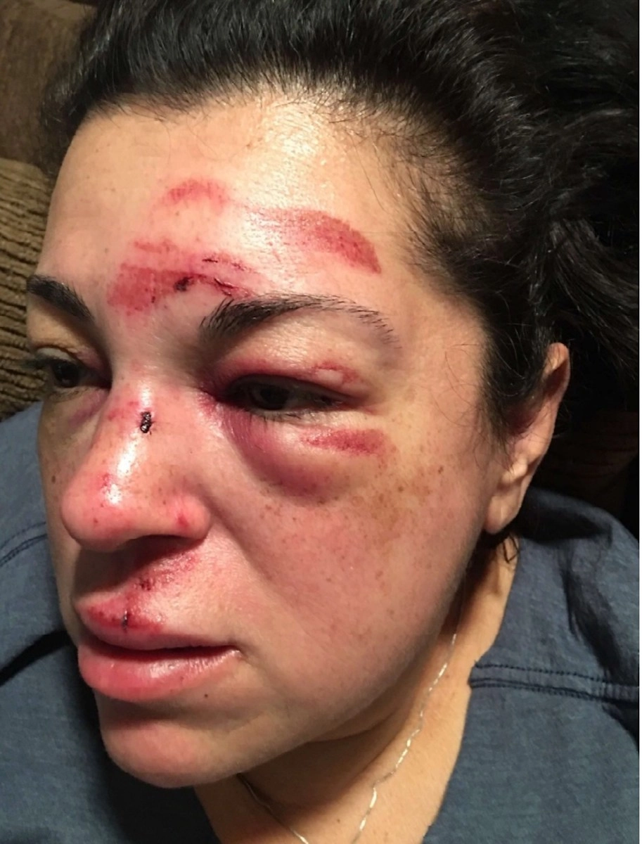 They will compensate 75 million for a teacher who suffers fall on a sidewalk in bad condition