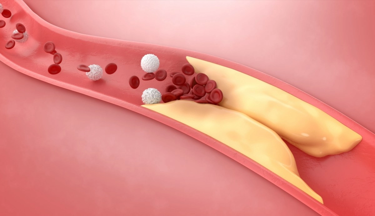 Highlights advances in gene therapy to reduce high cholesterol permanently
