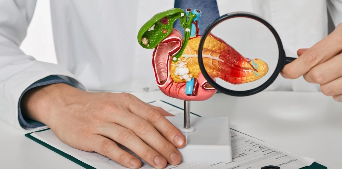 Pancreatic cancer one of the most aggressive