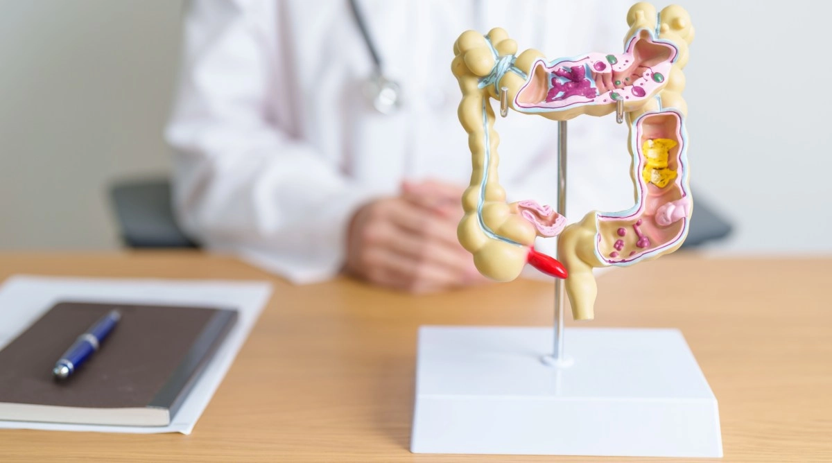 El cncer colorrectal es el que ha causado ms muertes en personas menores de 50 aos