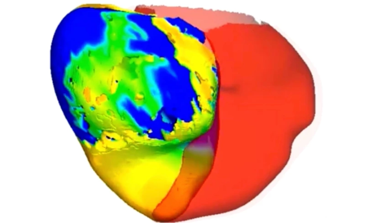 Doctors trieddigital twin to correct a patients irregular heart rhythm