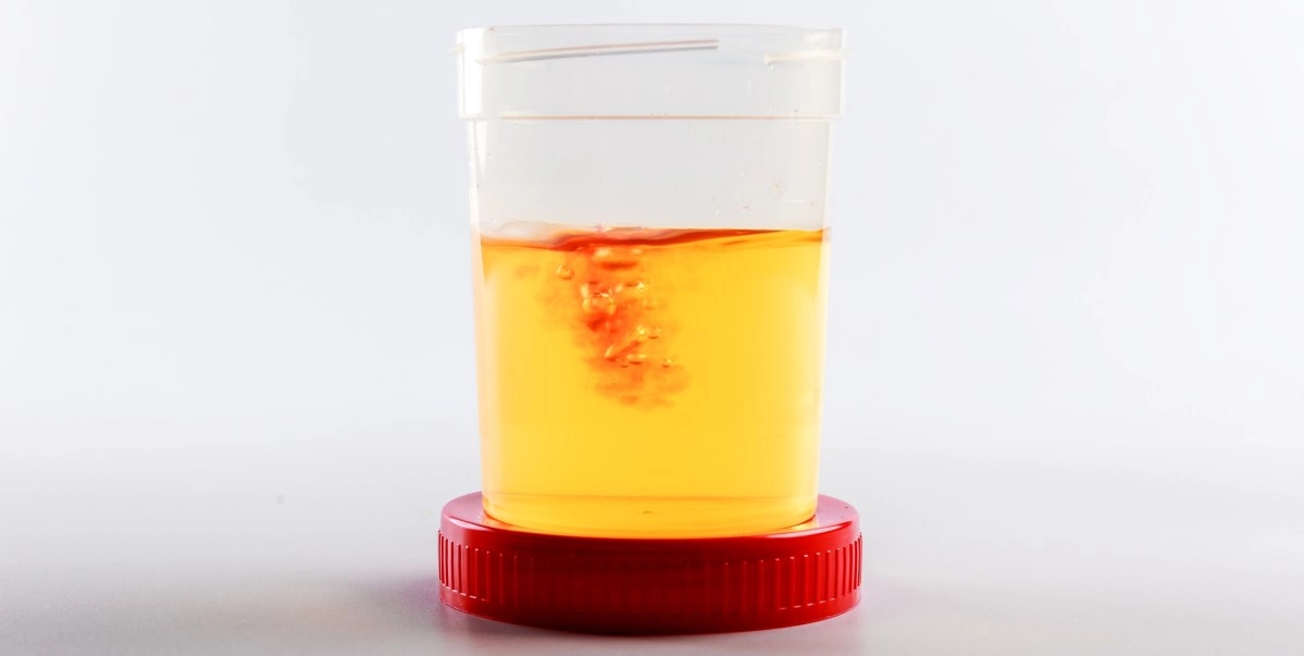 Blood in the urine the main symptom of bladder cancer