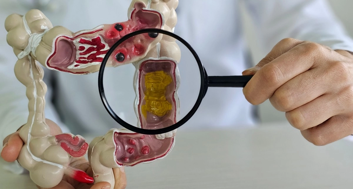 Impact of inflammatory bowel disease the importance of early detection