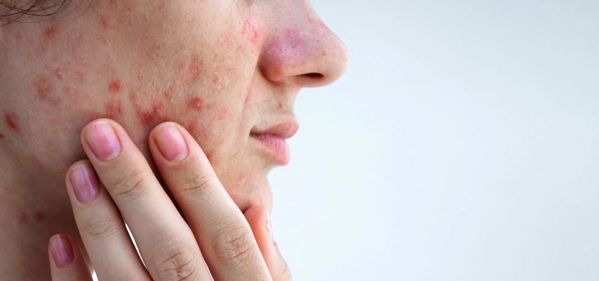 Acne is not just a problem for teenagers