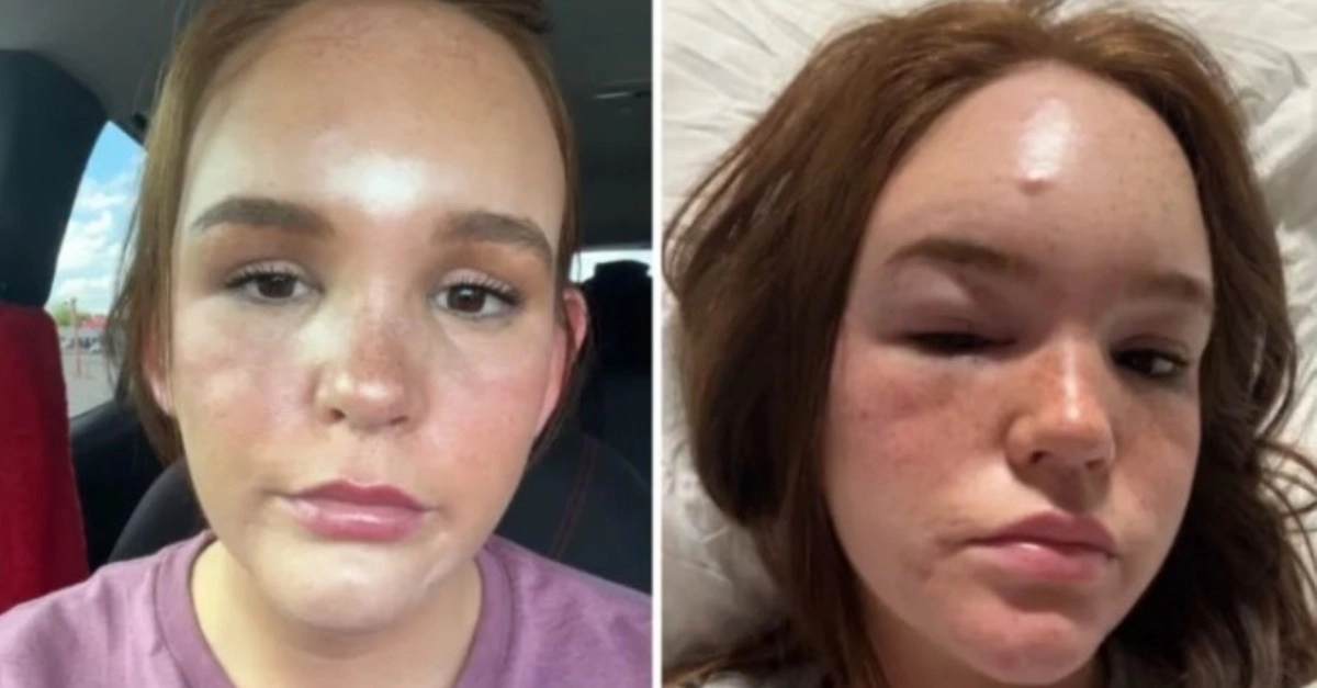 A sting that resulted in a medical nightmare