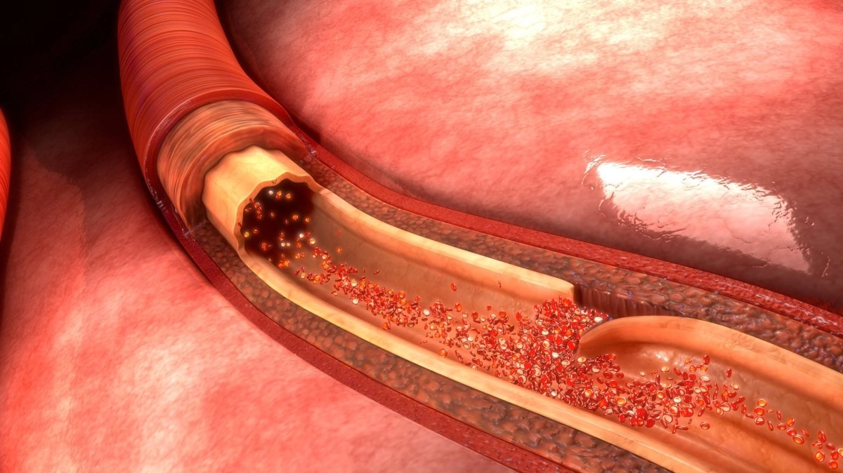 Aortic dissection can cause serious internal bleeding rare heart condition caused death of Senator Graham