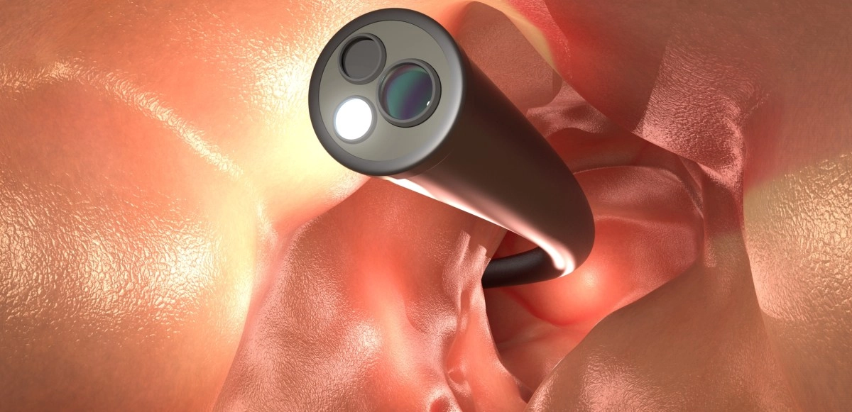 They develop promising vaccines to intercept colon cancer