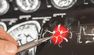 First non-antipsychotic drug approved for agitation in Alzheimer's disease