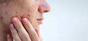 Acne is not just a problem for teenagers