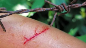 Cases of tetanus are increasing, it is a rare but dangerous disease