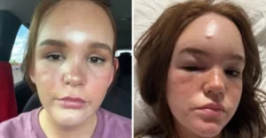 A sting that resulted in a medical nightmare